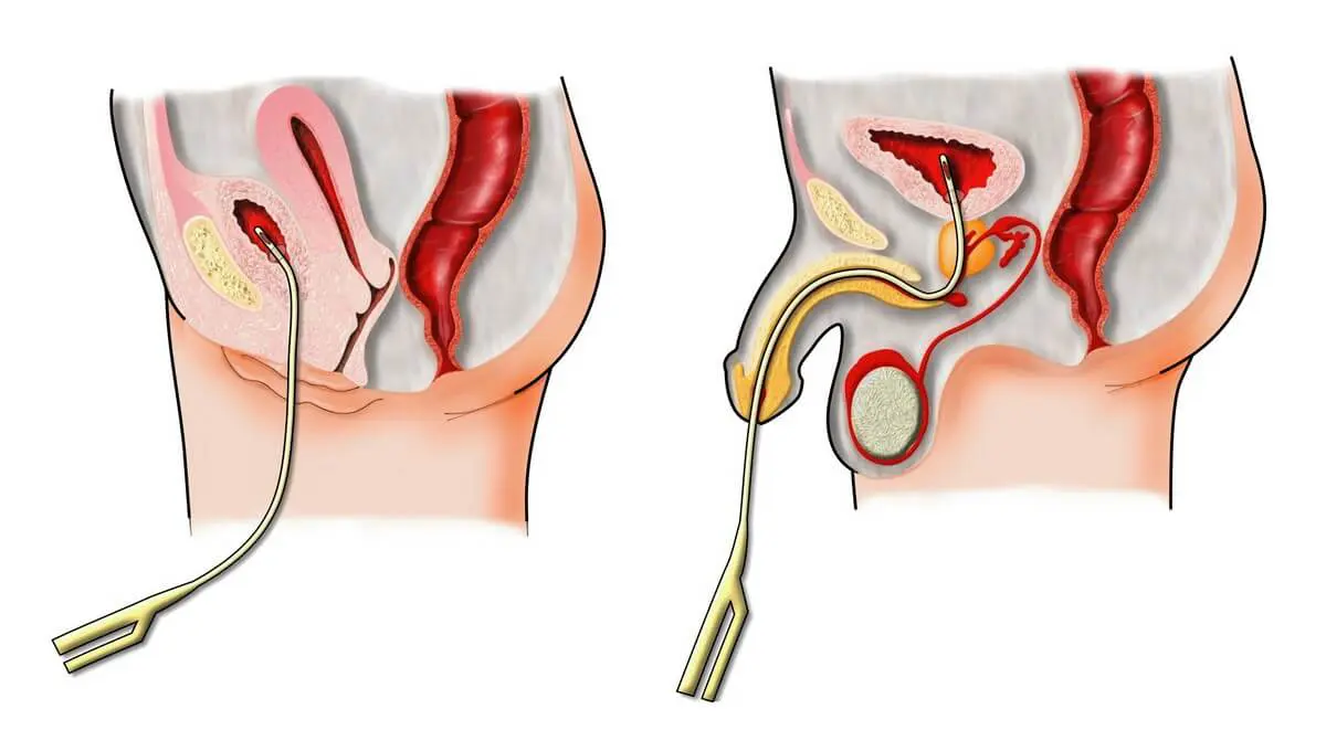 Pose d'une sonde urinaire - Revinax