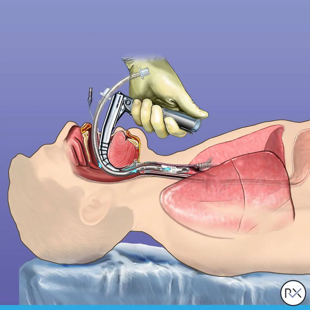 intubation