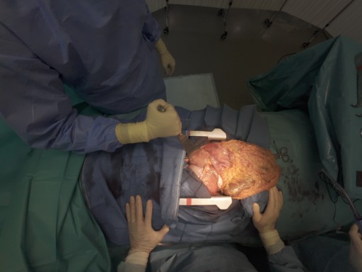 dissection colo épiploique