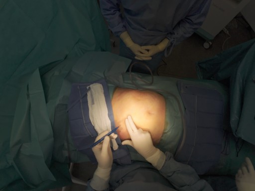 cholécystectomie cholangiographie perop
