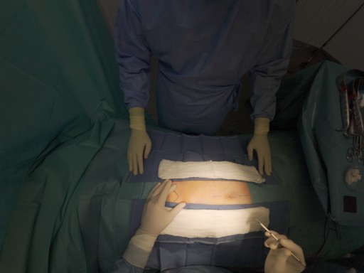 laparotomie médiane
