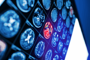 neurochirurgie lmc
